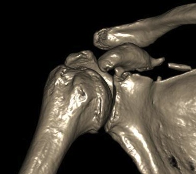 Coracoid Fracture CT 1